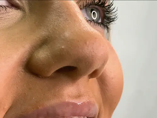 Close-up of a smile after composite bonding at Park Place Dental