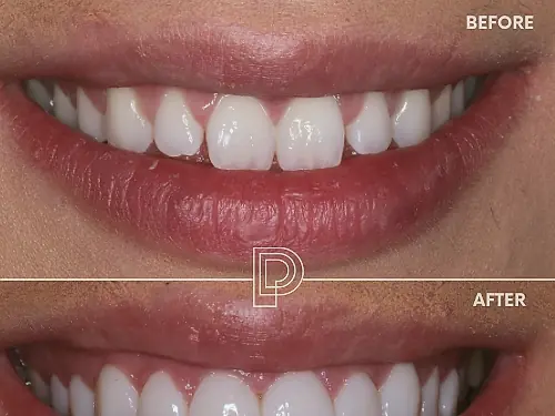 A smile restored with porcelain veneers at Park Place Dental